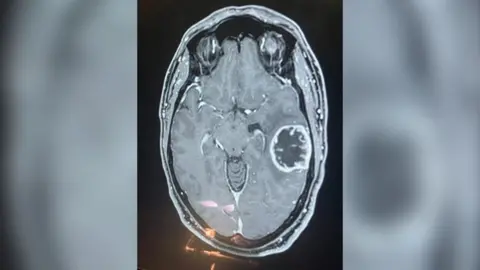 5f0ebea0-356b-11f0-8947-7d6241f9fce9 5f0ebea0-356b-11f0-8947-7d6241f9fce9 Charles Trigg An x-ray of a brain tumour New brain tumour test a 'game changer', say experts New brain tumour test a 'game changer', say experts 5f0ebea0 356b 11f0 8947 7d6241f9fce9