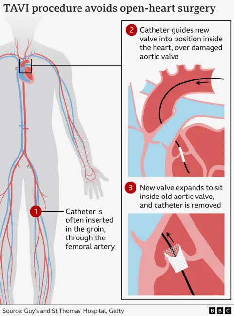 45f81590-3d5b-11f0-af00-f94ff1cabcc0 45f81590-3d5b-11f0-af00-f94ff1cabcc0 Graphic illustrating how the TAVI procedure works by inserting a new valve via a catheter through a blood vessel. Police investigate heart deaths at NHS hospital 45f81590 3d5b 11f0 af00 f94ff1cabcc0