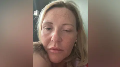 9c692b50-4d17-11f0-9efb-9fc6c4760a4c 9c692b50-4d17-11f0-9efb-9fc6c4760a4c Nicola Fairley Close-up selfie image of Nicola Fairley, who has shoulder-length blond hair and freckles. Her left eye is almost fully closed. 'I was poisoned by fake Botox' 9c692b50 4d17 11f0 9efb 9fc6c4760a4c
