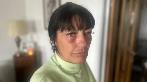 67cc9390-5678-11f0-95fc-edf89039c20a 67cc9390-5678-11f0-95fc-edf89039c20a Paula Harrison, a woman in her 50s with black hair and wearing a lime green top. She has a large red rash beneath each eye and her left eye lid is drooping. Woman left fighting for life as fake Botox beautician apologises 67cc9390 5678 11f0 95fc edf89039c20a