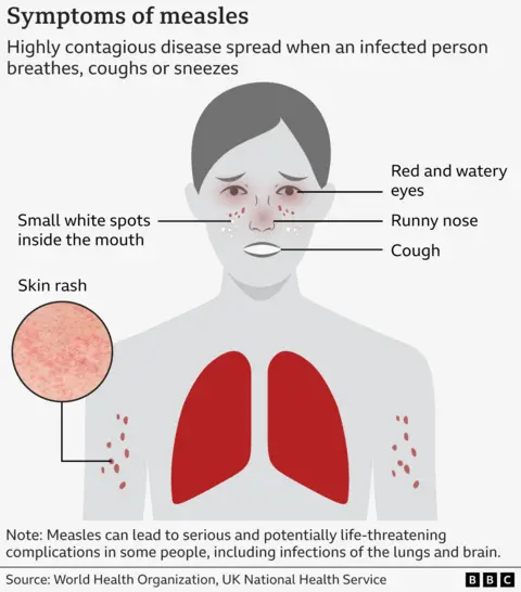 c443aa90-618c-11f0-a40e-a1af2950b220 c443aa90-618c-11f0-a40e-a1af2950b220 Graphic showing how measles symptoms present on a body, including red and watery eyes, runny nose, a cough, a skin rash and small white spots inside the mouth. The lungs are also highlighted, reflecting the risk of possible pulmonary infection. Why are measles cases rising in the UK? c443aa90 618c 11f0 a40e a1af2950b220